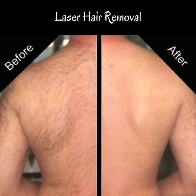 Процедура Endospheres therapy в Чернигове: фото антицеллюлитный массаж