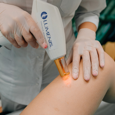 Удаление рубцов Lumenis M22