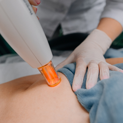 Удаление растяжек Lumenis M22