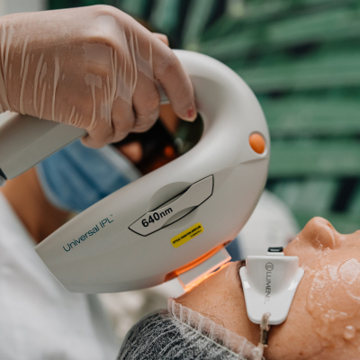 Фотоомоложение лица 