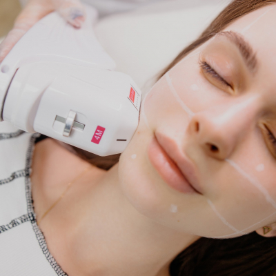 SMAS лифтинг нижняя треть 