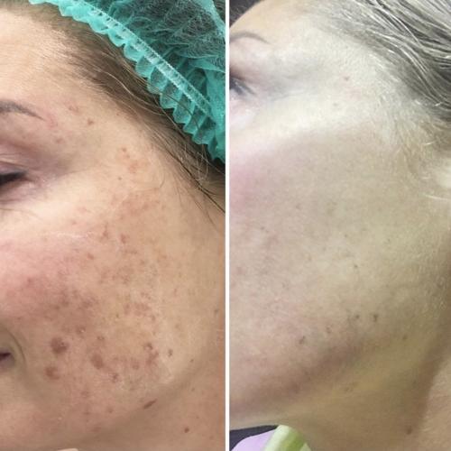 Лазерное удаление пигментации