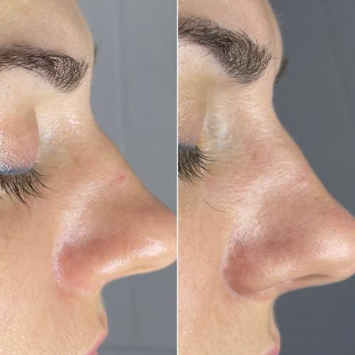 Чистка лица Indiba Ona