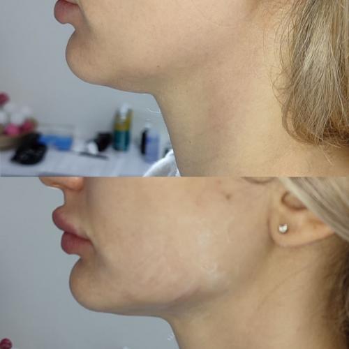 SMAS лифтинг лица