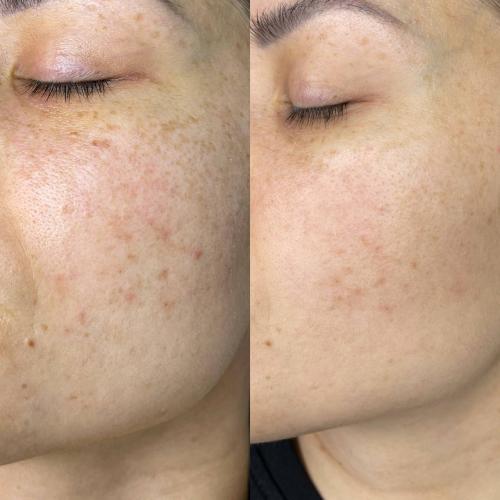 Фотоомоложение лица (термолифтинг) Lumenis M22