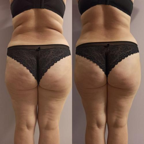 Результат после Endospheres Therapy