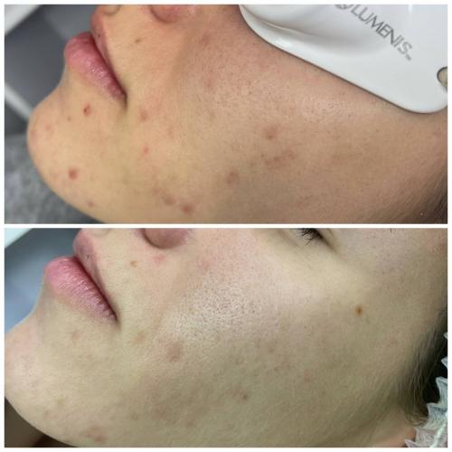 Лечение акне Lumenis M22