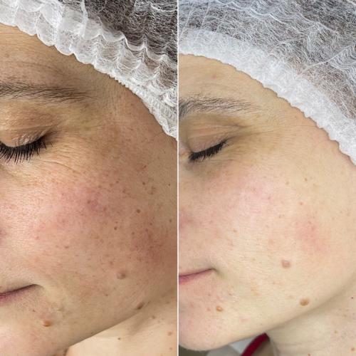 Фотоомоложение лица (термолифтинг) Lumenis M22