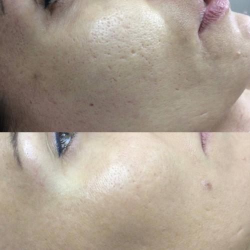 Лазерная шлифовка Lumenis M22