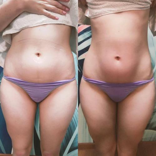 Расщепление жира на животе и боках после процедуры INDIBA