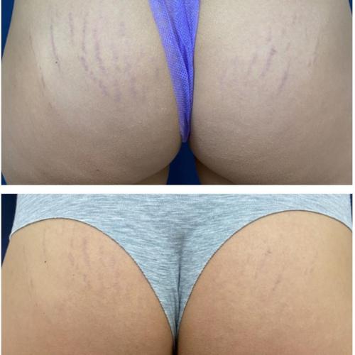 Удаление растяжек лазером на ягодицах платформа Lumenis M22