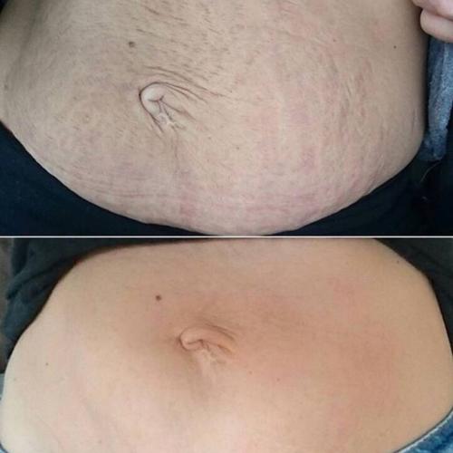 Результат удаления растяжек лазером Lumenis M22 на животе 