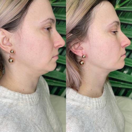 SMAS лифтинг лица