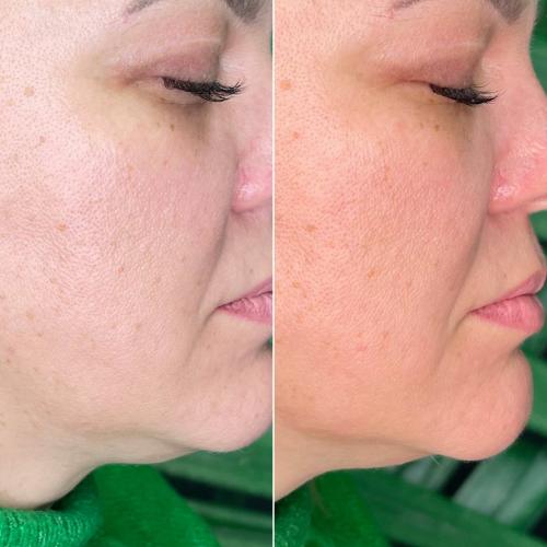 SMAS лифтинг лица