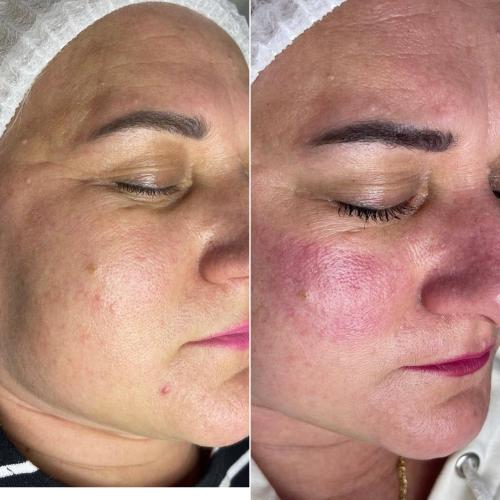 Фотоомоложение лица (термолифтинг) Lumenis M22