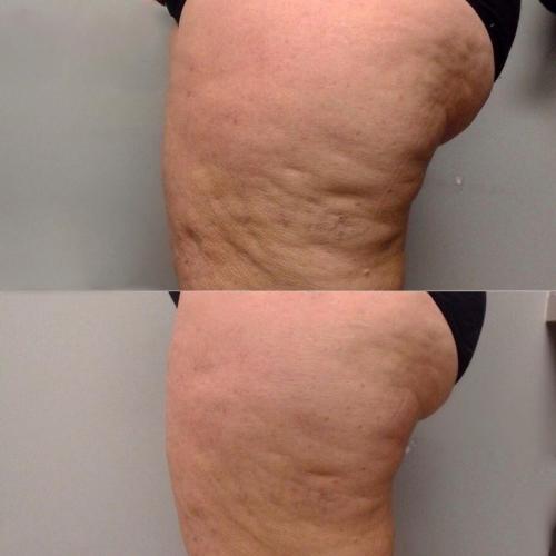 Результат после Endospheres Therapy