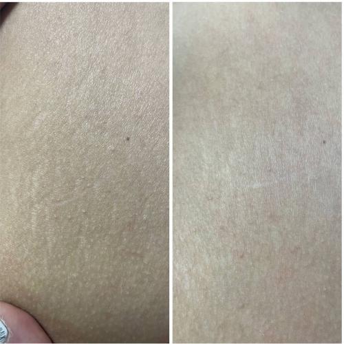 Результат удаления растяжек лазером на платформе Lumenis M22