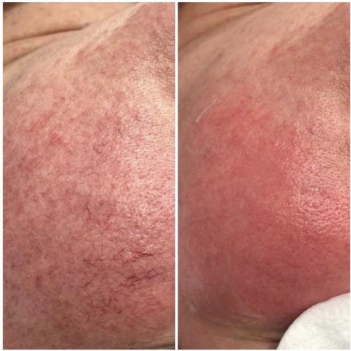 Удаление сосудов на лице Lumenis M22