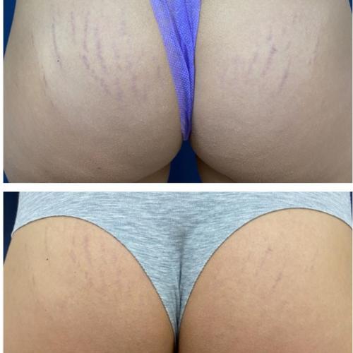 Удаление растяжек лазером на ягодицах платформа Lumenis M22