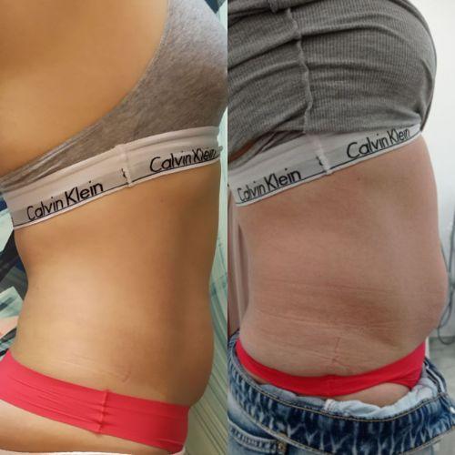 Зона живот-бока через 38 дней после криолиполиза