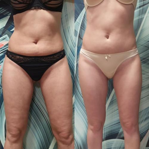 Результат после Endospheres Therapy