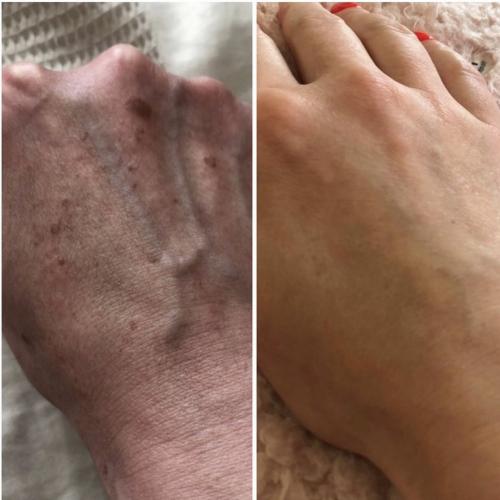 Лазерное удаление пигментации на руках