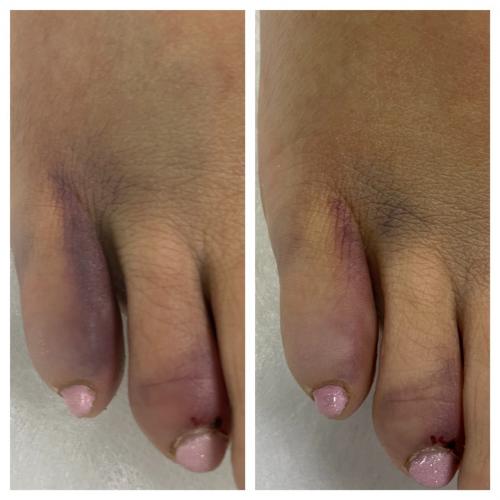 Лечение гематомы сразу после процедуры INDIBA