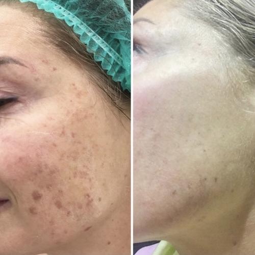 Лазерное удаление пигментации