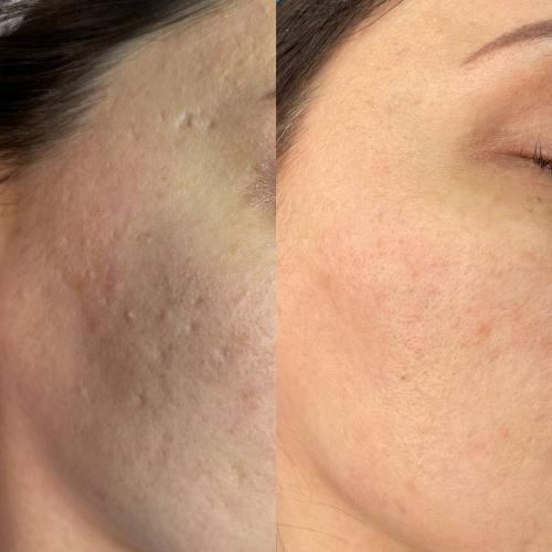 Лазерная шлифовка кожи Lumenis M22