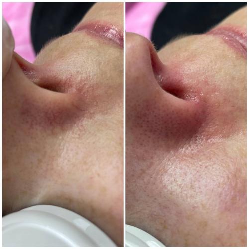 Удаление сосудов лазером Lumenis M22 на носу