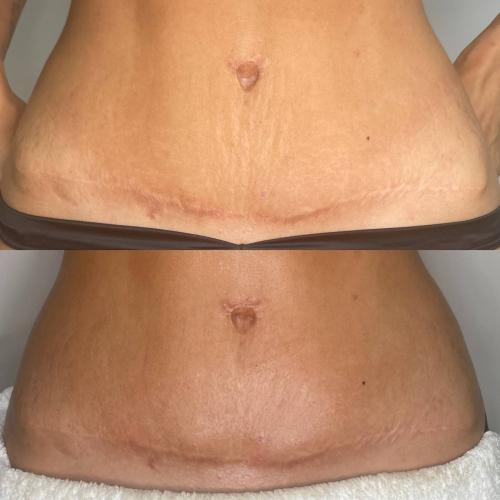 Растяжки на животе сразу после процедуры INDIBA
