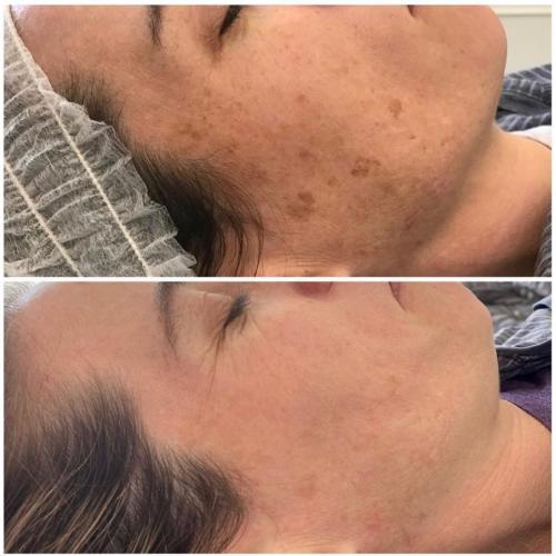 Лазерное удаление пигментации на лице