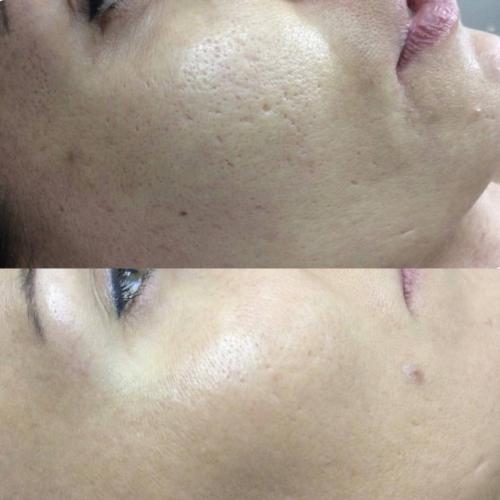 Лазерная шлифовка Lumenis M22