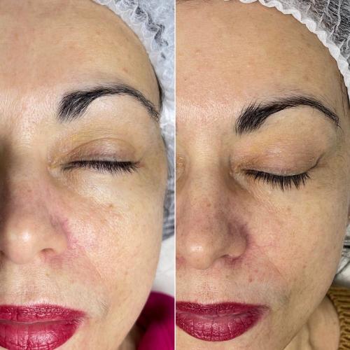 Чистка лица Indiba Ona