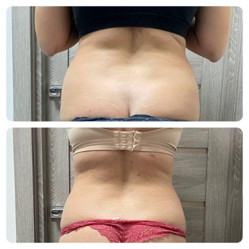 Зона живот-бока через 30 дней после криолиполиза