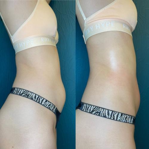 Расщепление жира на животе после процедуры INDIBA