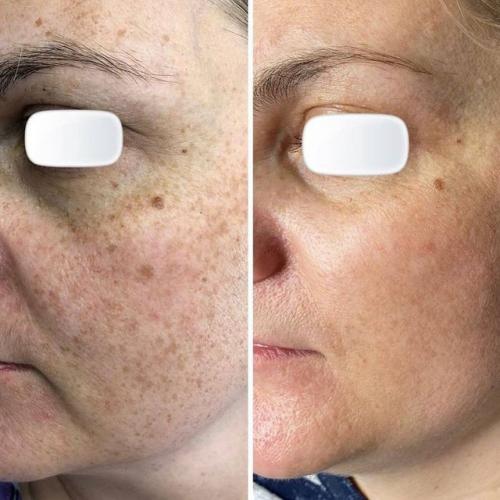 Лазерное удаление пигментации на лице Lumenis M22