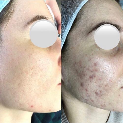 Лечение акне лазером 