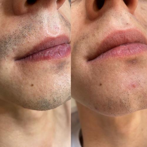 Результат после 2 сеансов лазерной эпиляции Lumenis Desire