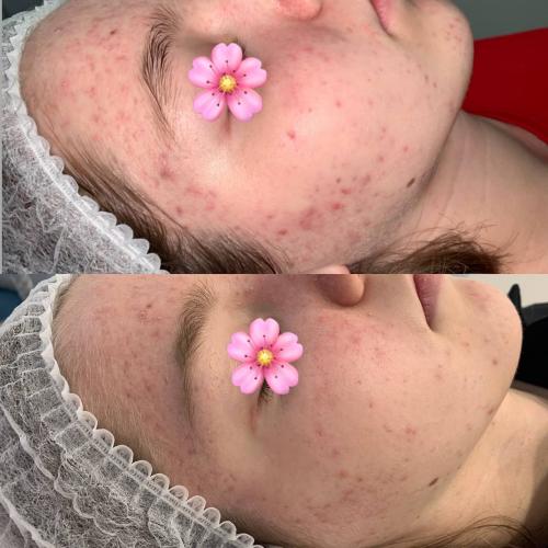 Лазерное лечение акне