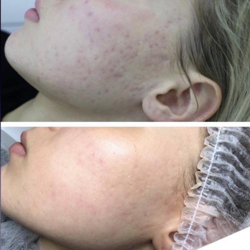 Лазерное лечение акне Lumenis M22