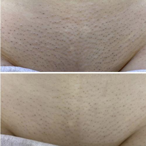 Результат после 1 сеанса лазерной эпиляции Lumenis Desire