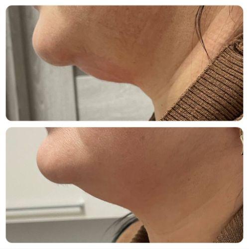 Зона подбородок через 15 дней после криолиполиза