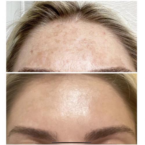 Лазерное удаление пигментации на лбу Lumenis M22