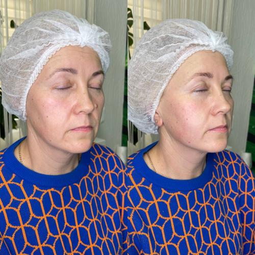 SMAS лифтинг лица