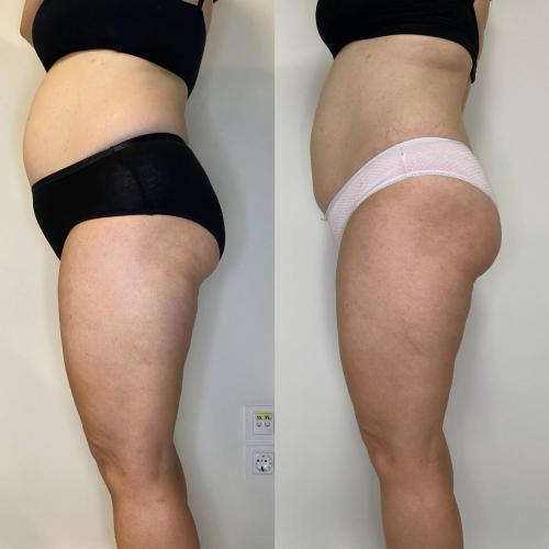 Результат после Endospheres Therapy