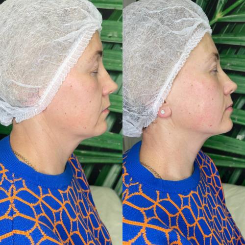 SMAS лифтинг лица