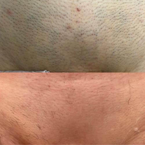 Результат после 4 сеансов лазерной эпиляции Lumenis Desire