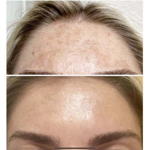 Лазерное удаление пигментации на лбу Lumenis M22