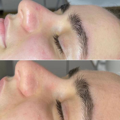 Чистка лица Indiba Ona